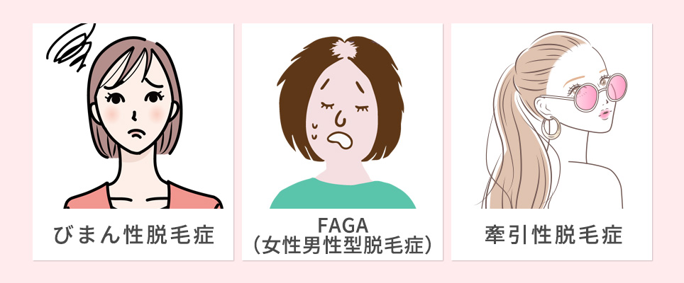 女性がなりやすい3つ脱毛症一覧